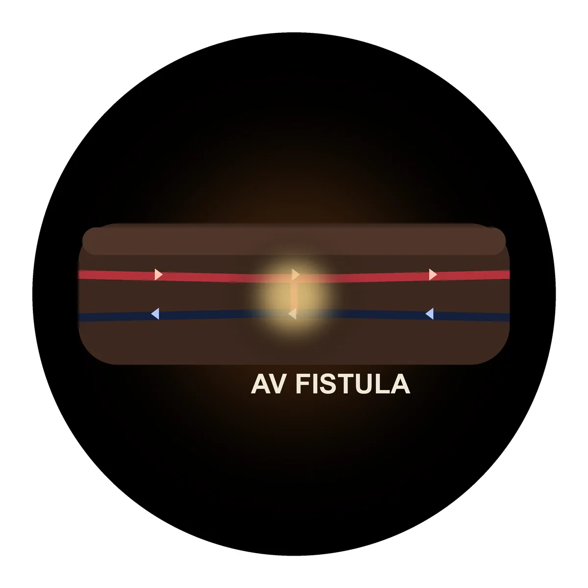 Fistula Diagram